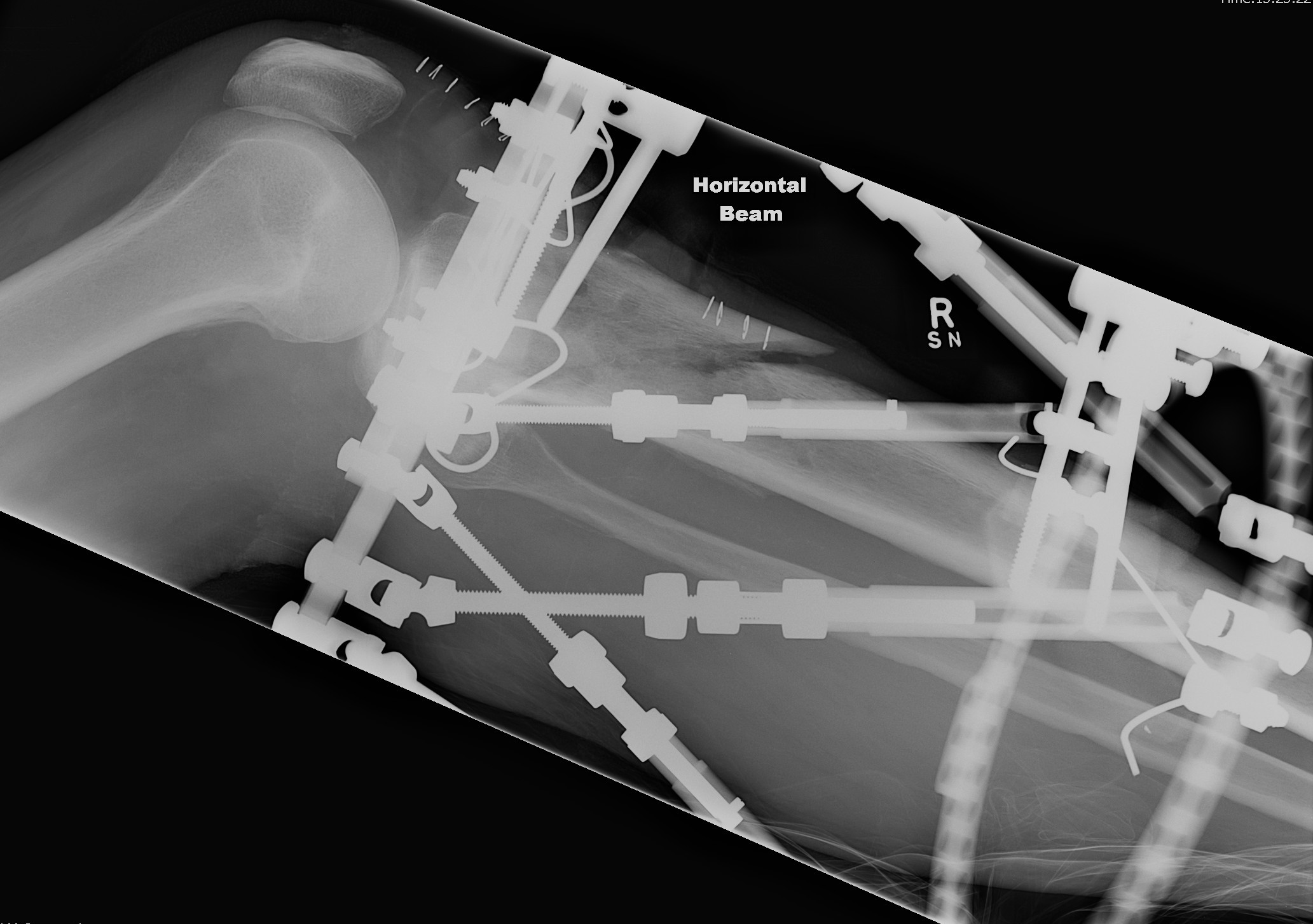 TSF Proximal Tibial Fracture Pre Correction